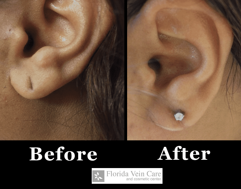 ear lobe before and after