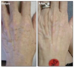 liver spots treated laser